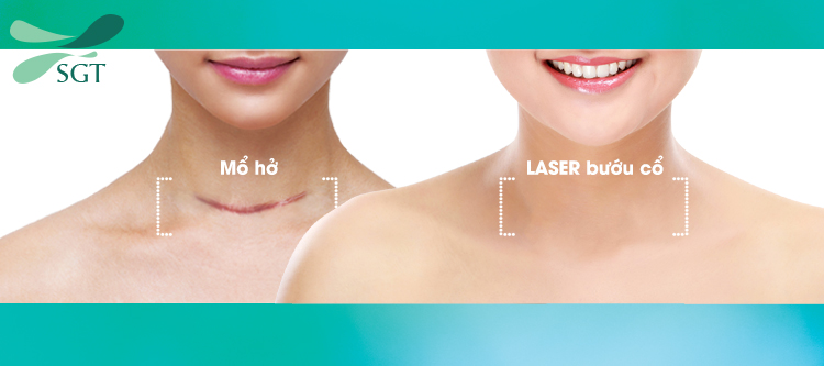 Điều trị bướu giáp nhân bằng laser không để lại sẹo như mổ bướu cổ
