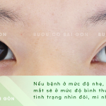 Bệnh tuyến giáp ảnh hưởng đến mắt tùy mức độ nặng nhẹ