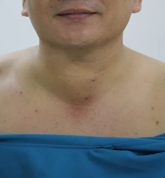 Vùng cổ bệnh nhân trước khi phẫu thuật tuyến giáp