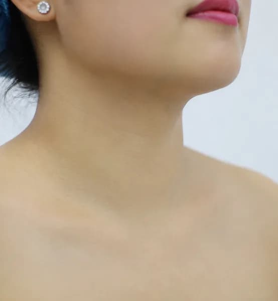 Vùng cổ bệnh nhân sau khi điều trị RFA