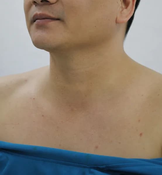 Vùng cổ bệnh nhân sau khi phẫu thuật tuyến giáp