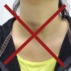 Đắp lá, đắp thuốc vào vùng bướu cổ có thể gây nhiễm trùng, để lại sẹo xấu trước cổ