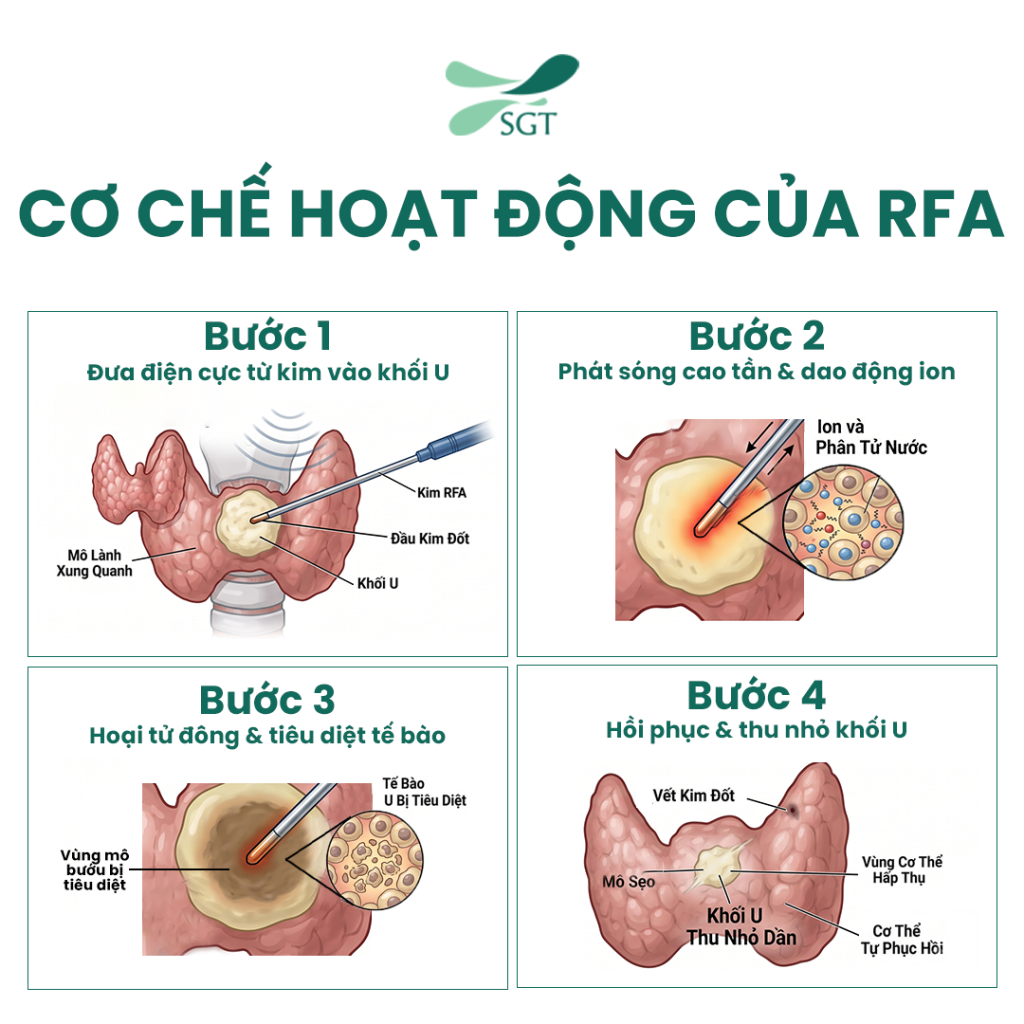 Cơ chế tiêu diệt tế bào bướu giáp nhân bằng nhiệt năng của sóng cao tần RFA
