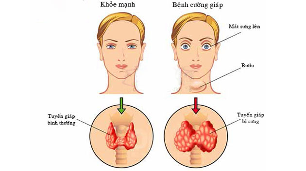 Bướu cổ ác tính có thể xuất hiện ở độ tuổi nào?
