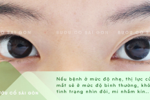 Bệnh tuyến giáp ảnh hưởng đến mắt tùy mức độ nặng nhẹ