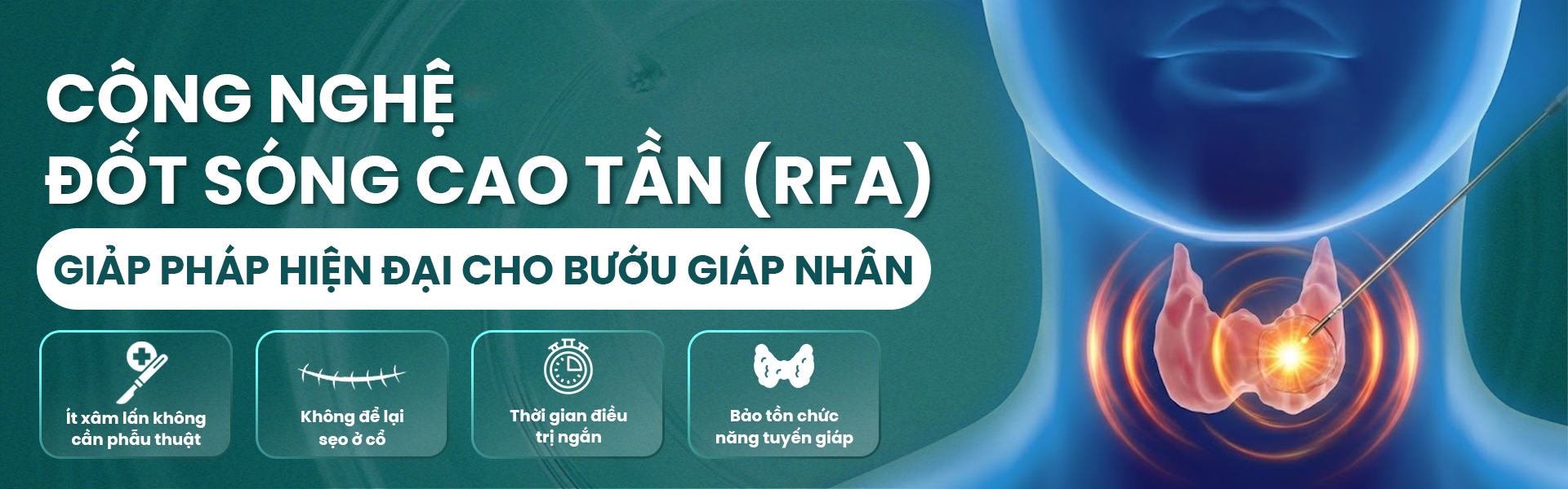 Điều trị bướu giáp nhân bằng sóng cao tần