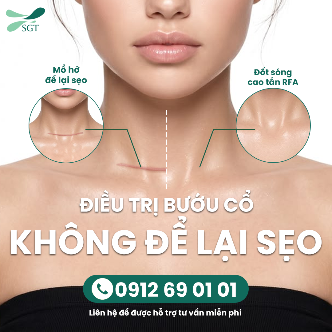 Điều trị bướu cổ không để lại sẹo