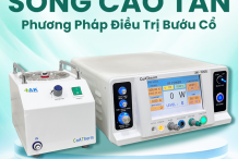 Điều trị bướu cổ bằng sóng cao tần