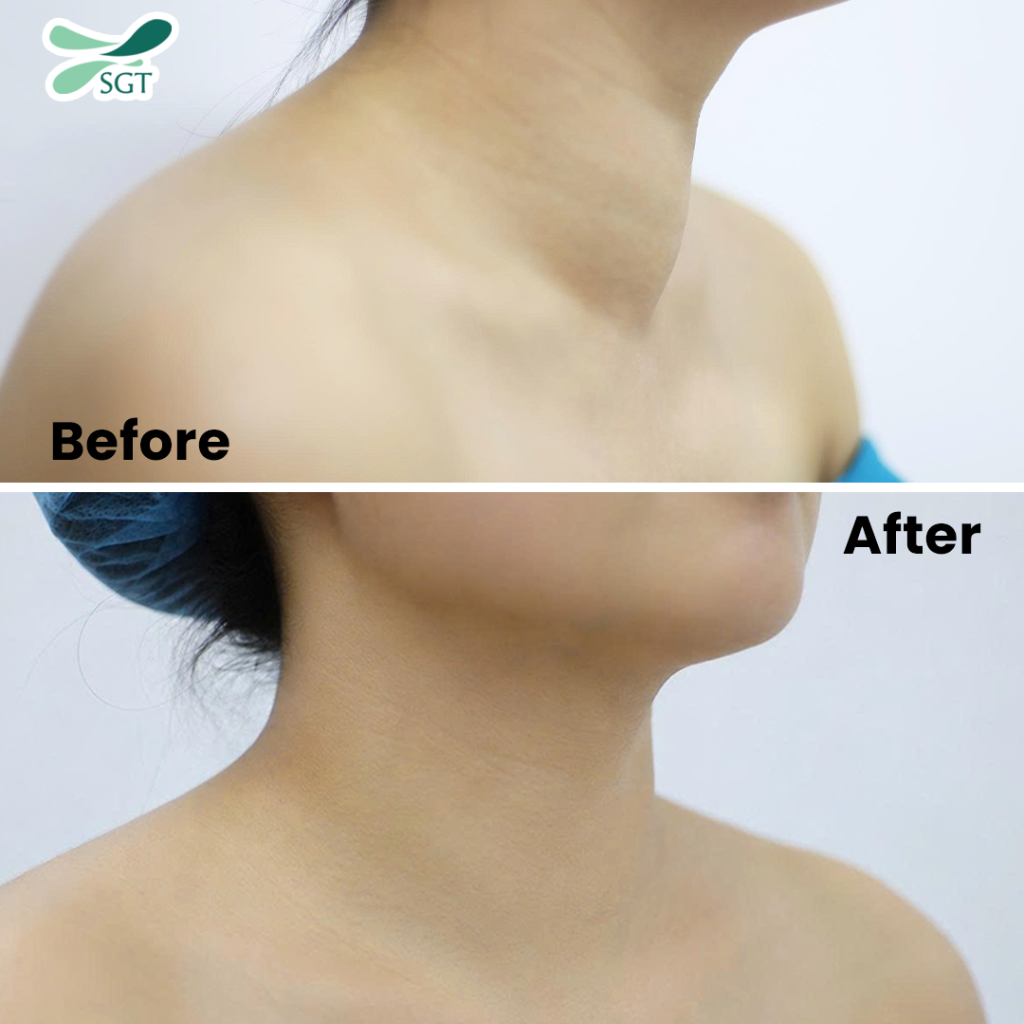 Bệnh nhân phục hồi nhanh chóng, không để lại sẹo cổ sau khi đốt sóng cao tần bướu giáp.