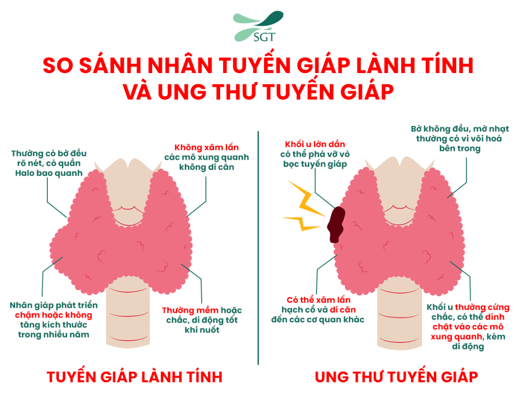 so sánh nhân tuyến giáp lành tính và ung thư tuyến giáp